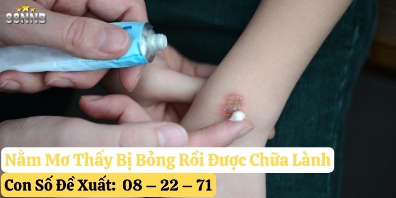 nằm mơ thấy bị bỏng 88nn