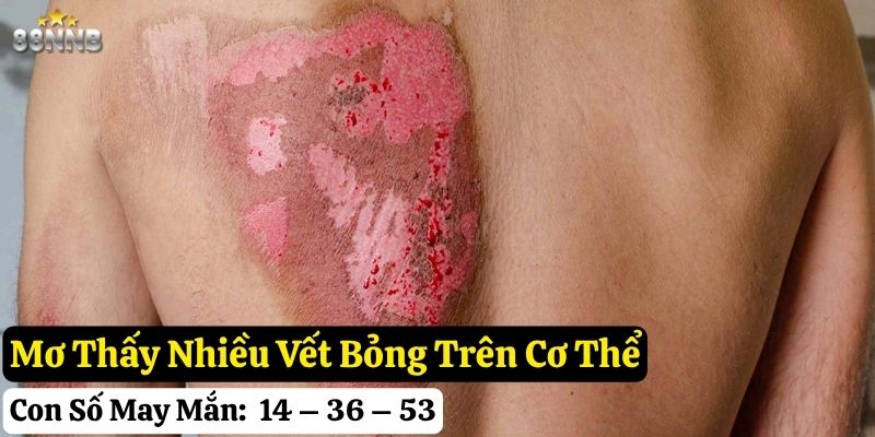 nằm mơ thấy bị bỏng