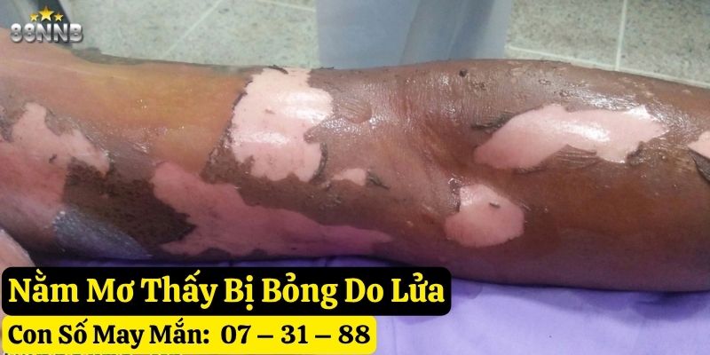 mơ thấy bị bỏng